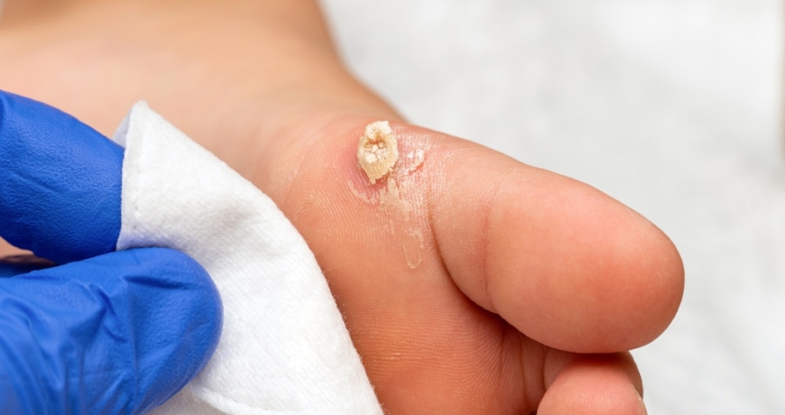 Homeopathy treatment for corns on hands and feet in Baner Pune
