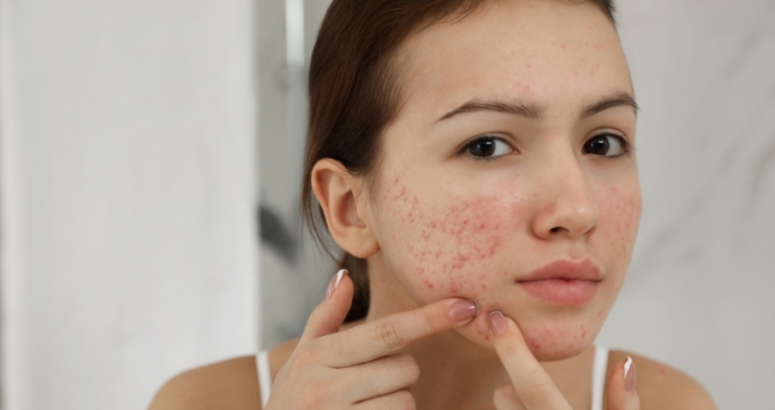Homeopathy treatment for skin diseases like eczema psoriasis and acne in Baner Pune